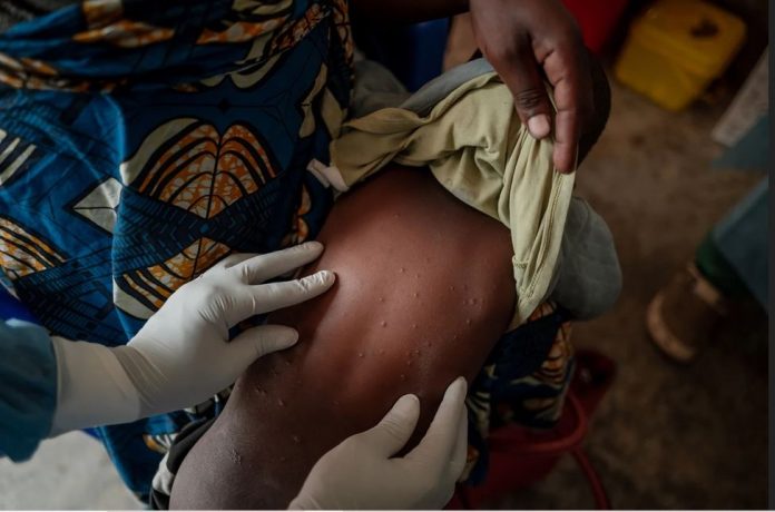 examination-of-child-at-mpox-treatment-centre - WHO photo